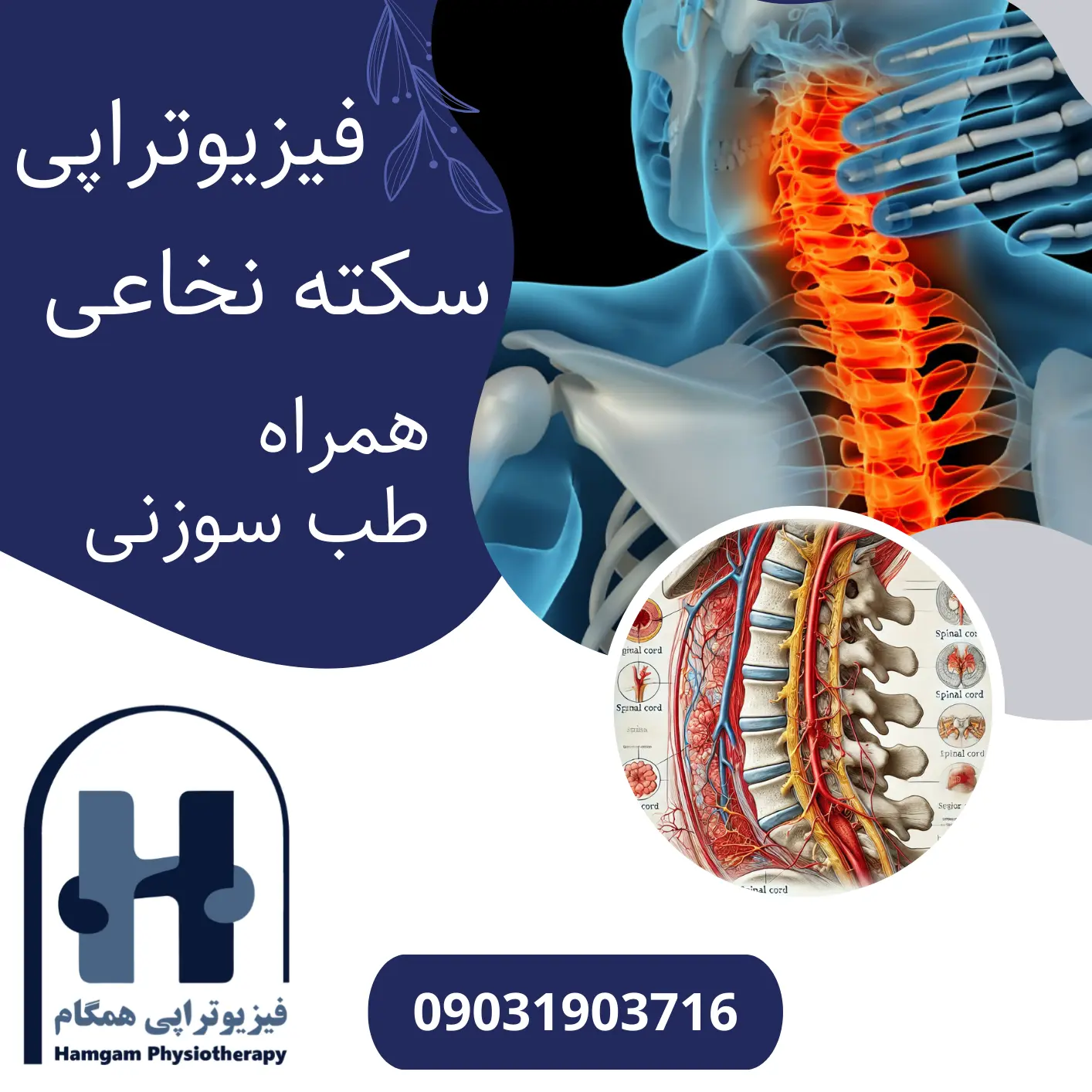 سکته-نخاعی-توانبخشی-و-فیزیوتراپی-Spinal-Stroke-طب-سوزنی